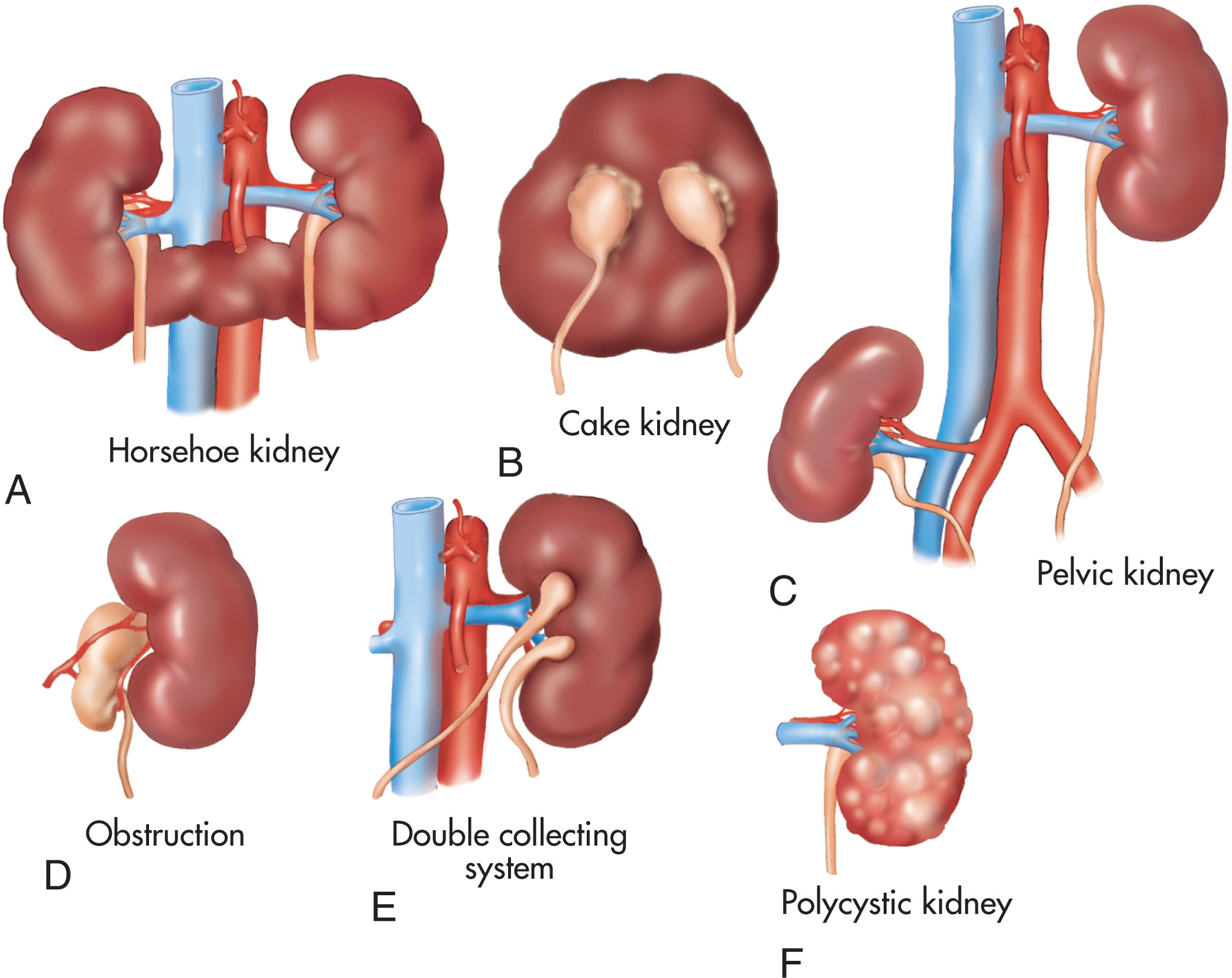 Fig. 64.12, Variations of the kidney. (A) Horseshoe kidney shown as two kidneys connected by an isthmus anterior to the aorta and inferior vena cava. (B) “Cake” kidney that has failed to divide with a double collecting system. (C) Pelvic kidney with one kidney in the normal retroperitoneal position. (D) Extrarenal pelvis. (E) Double collecting system. (F) Polycystic kidney.