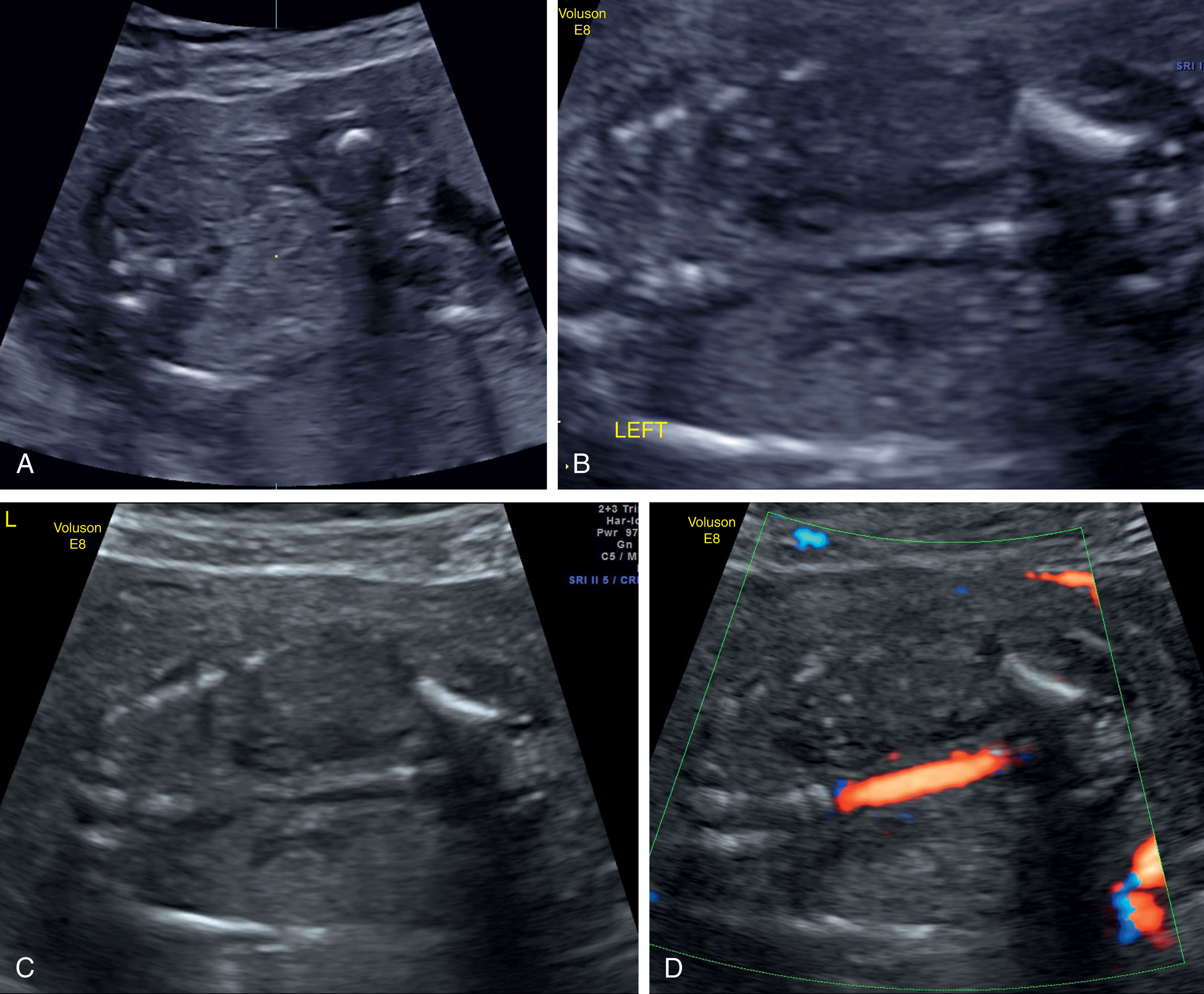 Fig. 64.14, (A) Transverse image of the abdomen does not demonstrate the right and left kidney. (B) Coronal image of the fetal abdomen demonstrating nonvisualization of the kidneys. (C) The adrenal glands appear hypoechoic and flat in the coronal image. (D) Use of Doppler at the level of the renal arteries demonstrates absence of both renal arteries.