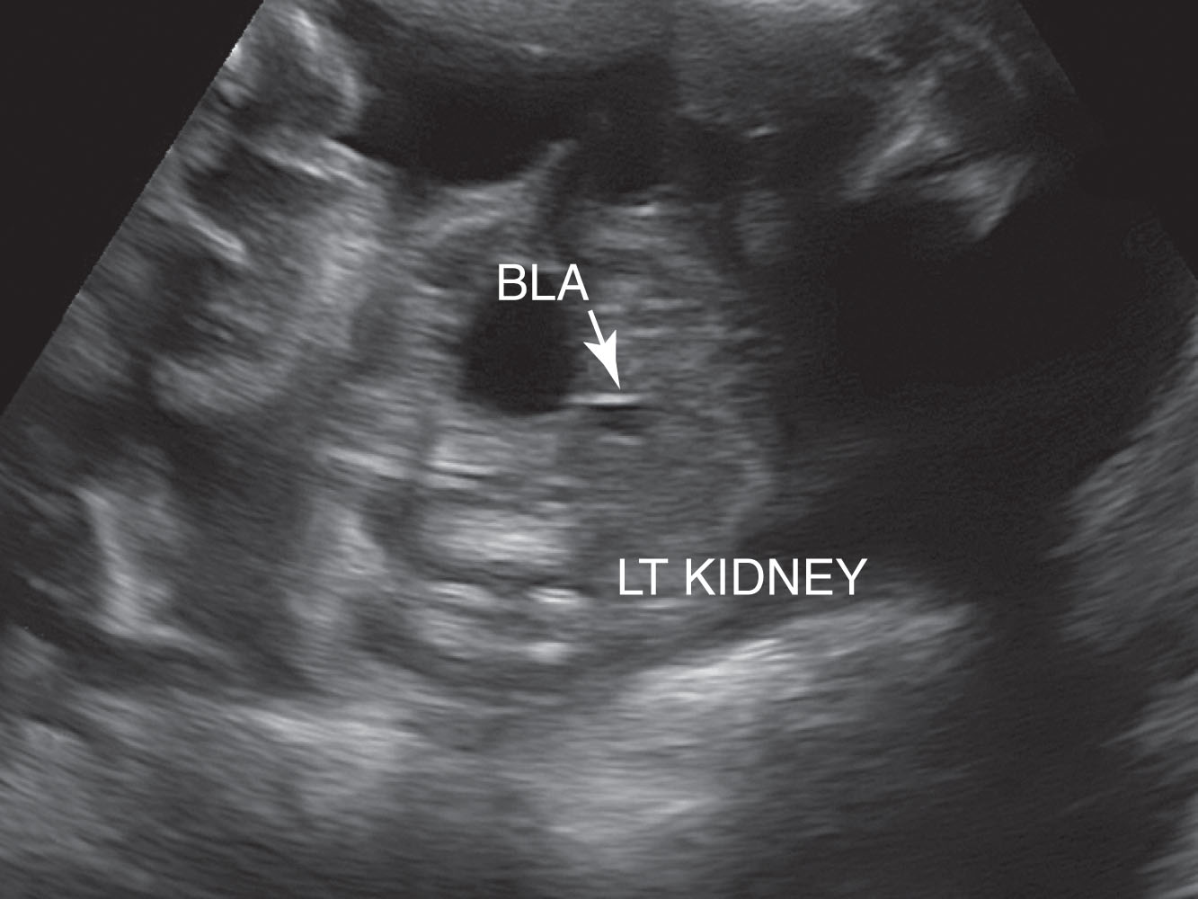 Fig. 64.15, The left kidney was not seen in its normal location in this 23-week-old fetus. Further evaluation of the fetus identified the left kidney adjacent to the bladder in the lower pelvis.