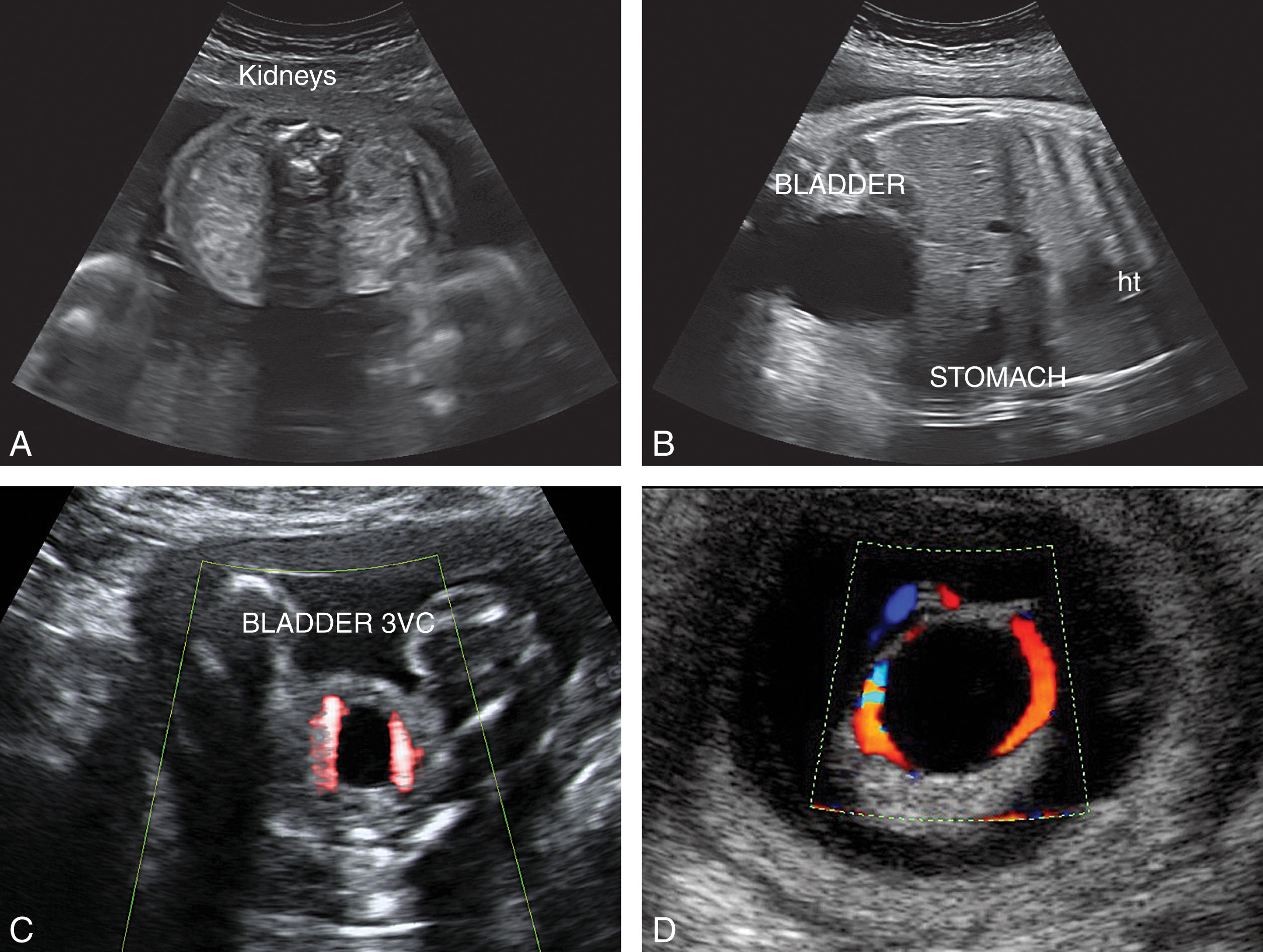 Fig. 64.7, (A) Normal kidneys in the transverse view located on either side of the fetal spine. The anterior position of the spine provides optimal resolution for evaluating the kidneys. (B) The anechoic bladder is noted caudal in the fetal body as it relates the anechoic fetal stomach. (C) The bladder is noted lying between, low within the pelvis. Color Doppler reveals arterial blood flow on each side of the bladder, supporting the findings of a three-vessel cord (3VC). (D) An obstructed fetal bladder is noted in an early second-trimester fetus. Color Doppler reveals the presence of a three-vessel cord. ht , Heart.