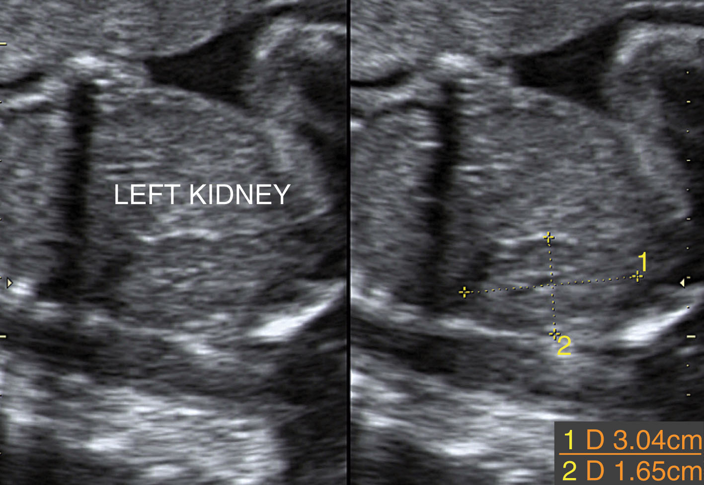 Fig. 64.8, A length measurement of the left kidney is 3.04 cm. This is in normal range for the 30-week-old fetus. The length of a normal kidney reflects the approximate gestational age of the fetus.