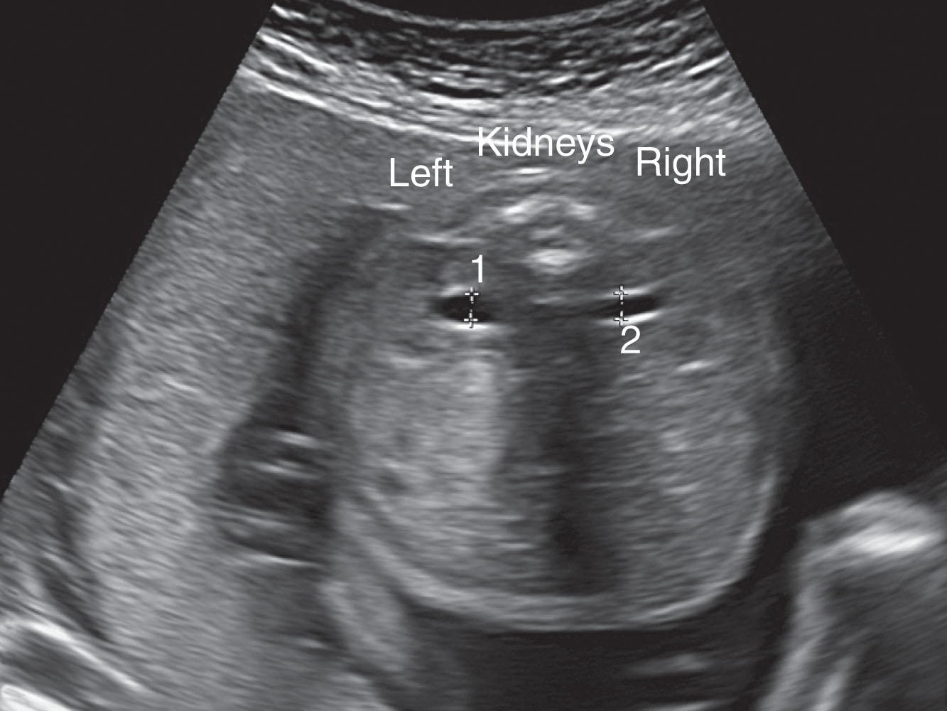 Fig. 64.9, A normal amount of fluid is noted within the renal pelvis. Anterior-posterior diameters reflect the amount of pyelectasis.