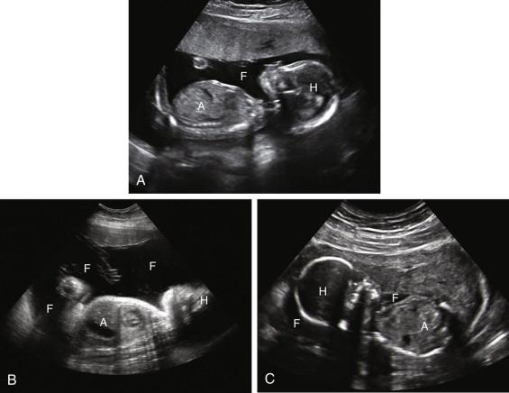 F igure 13-1, Subjective assessment of amniotic fluid volume. Longitudinal images of the gravid uterus in second-trimester pregnancies show ultrasound appearance of normal and abnormal amniotic fluid volume. A, Normal amniotic fluid volume. A normal volume of fluid is seen adjacent to the fetus. B, Polyhydramnios. Note the disproportionately large amount of fluid anterior to the fetus. C, Oligohydramnios. There is crowding of fetal parts, with only small pockets of fluid seen. A, Fetal abdomen; F, amniotic fluid; H, fetal head.