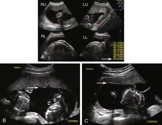 F igure 13-2, Quantitative measurement of amniotic fluid volume. A, Amniotic fluid index (AFI). The deepest fluid pocket without fetal parts or the umbilical cord has been measured in the right upper (RU), right lower (RL), left lower (LL), and left upper (LU) quadrants of the gravid uterus. The values of 6.3, 2.4, 1.8, and 4.3 cm have been added together, consistent with a normal AFI of 14.8 cm (arrow) . B and C, Maximum vertical pocket (MVP) measurement of amniotic fluid in a twin pregnancy. The deepest fluid pocket without fetal parts or the umbilical cord has been measured (arrows) for the gestational sacs of twin A (image B ) and twin B (image C ). The MVP values of 5.8 cm for twin A and 4.9 cm for twin B are both normal (normal range 2 to 8 cm).