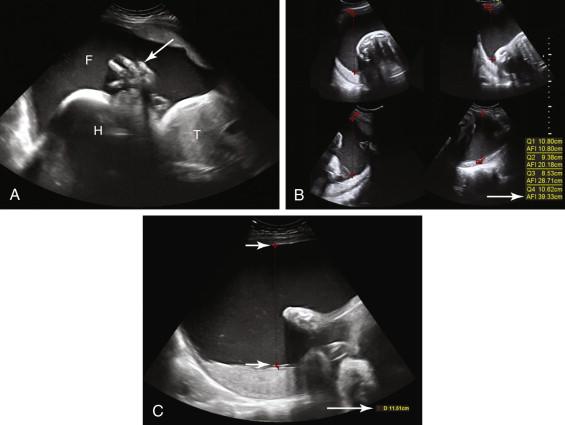 F igure 13-3, Polyhydramnios. A, Longitudinal image of a gravid uterus at 32 weeks shows polyhydramnios with a large amount of fluid (F) around the fetus. Arrow points to hand. B, Amniotic fluid index of 39.3 cm (arrow) is very high. C, Maximum vertical pocket measurement (short arrows) of 11.5 cm (long arrow) is also elevated. H, Head; T, thorax.