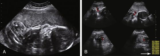 F igure 13-4, Oligohydramnios due to premature rupture of membranes. A, Longitudinal image of the uterus at 26 weeks shows severe oligohydramnios with only a tiny pocket of fluid (F) identified in this view. B, Amniotic fluid index of 3.4 cm (arrow) is consistent with severe oligohydramnios.