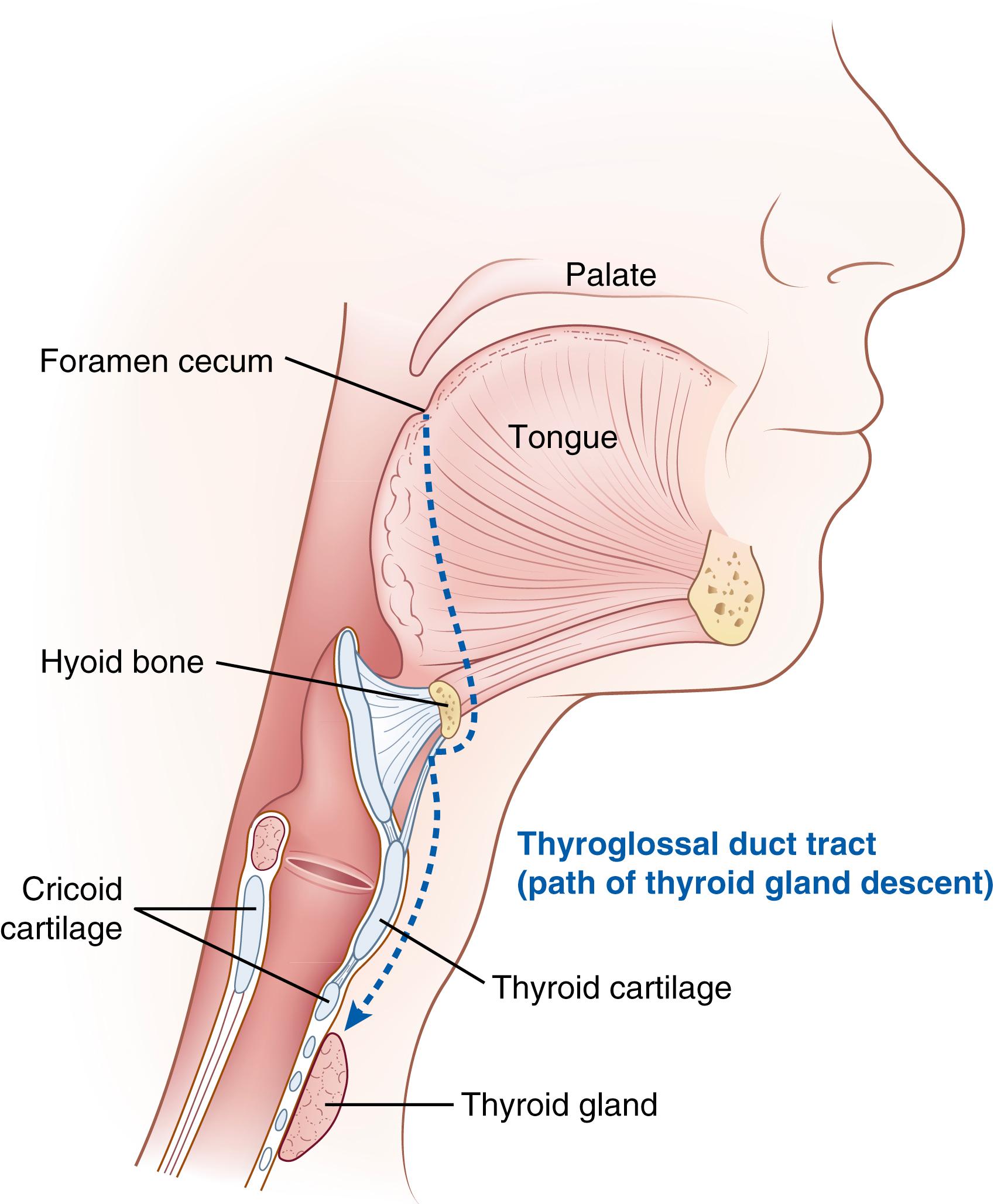 Fig. 145.1, The thyroid gland develops in the pharyngeal floor, migrating caudally through the foramen cecum along the thyroglossal duct tract to a location inferior to the cricoid cartilage by the seventh week of gestation. Failure to form (agenesis) or complete migration (dysgenesis with ectopic location) is the most common etiology of congenital hypothyroidism and may be secondary to mutations in several genes (see Table 145.1 ).