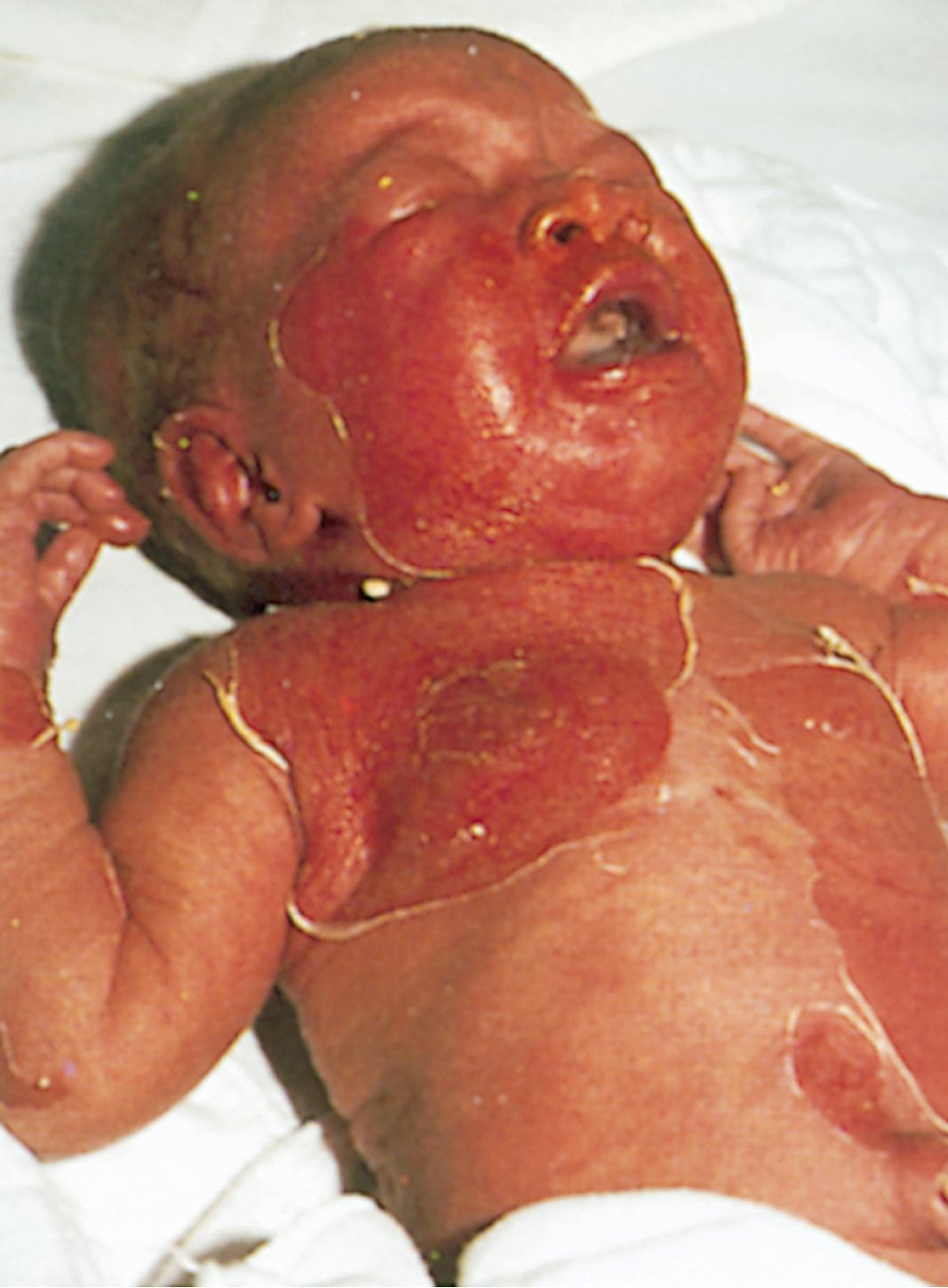 Fig. 53.11, An infant with staphylococcal scalded skin syndrome.