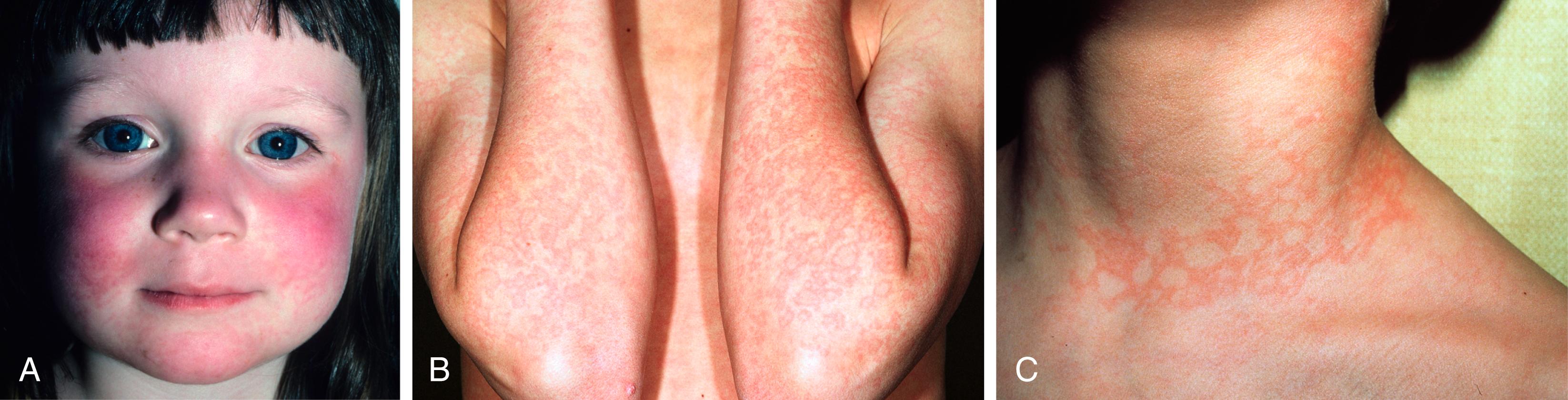 Fig. 53.12, A, Erythema infectiosum. Facial erythema (“slapped cheek”). The red plaque covers the cheek and spares the nasolabial fold and the circumoral region. B, A macular eruption appears on the extensor extremities. C, The eruption fades into a lacy netlike pattern.