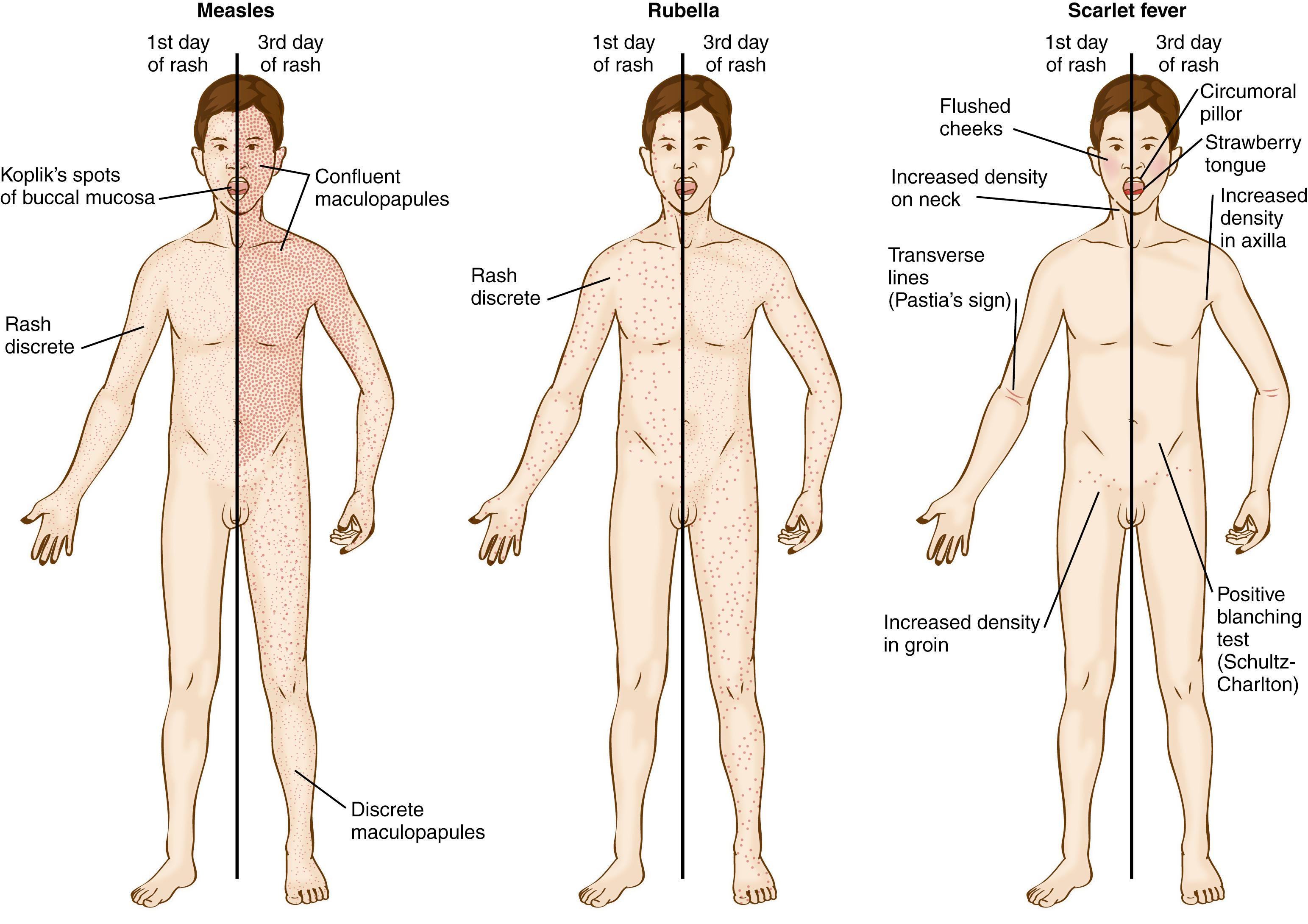 Fig. 53.2, Schematic drawings illustrating difference in appearance, distribution, and progression of rashes of measles, rubella, and scarlet fever.