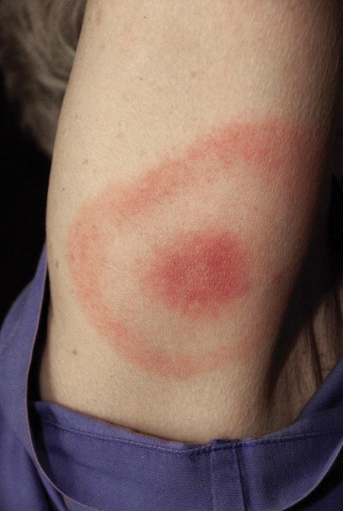 Fig. 53.3, Erythema migrans—erythematous target-like plaque of Lyme disease. The primary skin lesion of Borrelia burgdorferi infection is noted for centrifugal expansion, sometimes leaving a central clearing. The rash of southern tick–associated rash illness (STARI) is also similar to the rash of early Lyme disease.