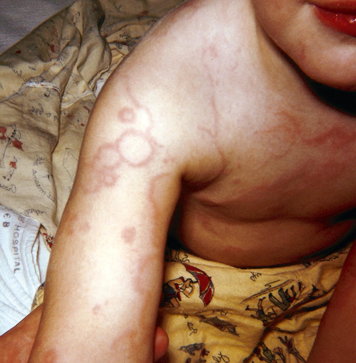 Fig. 53.4, Polycyclic red borders of erythema marginatum in a febrile child with acute rheumatic fever.