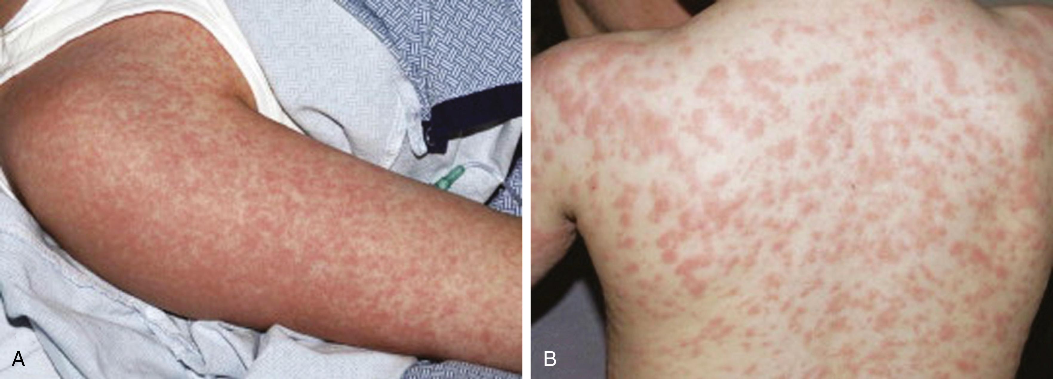 Fig. 53.5, Morbilliform drug eruptions. A, Fine, pink macules and thin papules becoming confluent on the posterior upper arm, which is a dependent area in this hospitalized patient. B , More edematous (“urticarial”) pink papules; unlike true urticaria, these lesions are not transient.