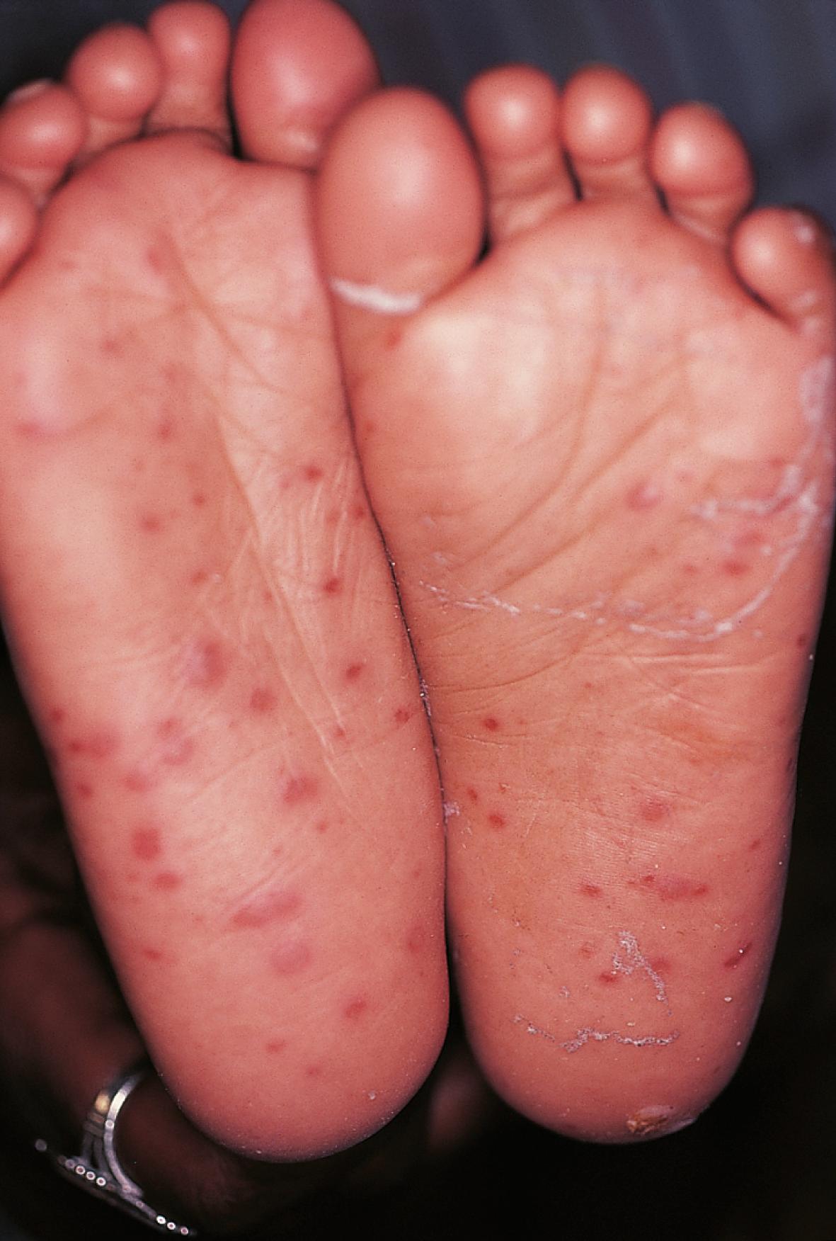 Fig. 53.7, Purpuric lesions in a patient with Rocky Mountain spotted fever.