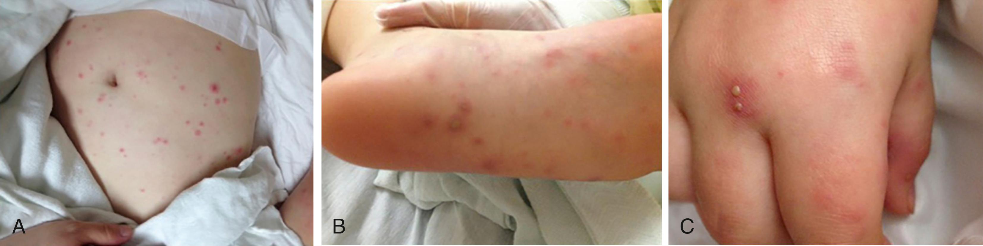 Fig. 53.8, Rat-bite fever. A, Erythematous papules on the abdomen. B, Purpuric pustules on the sole of the left foot. C, Pustules on erythematous bases on the right dorsal hand.