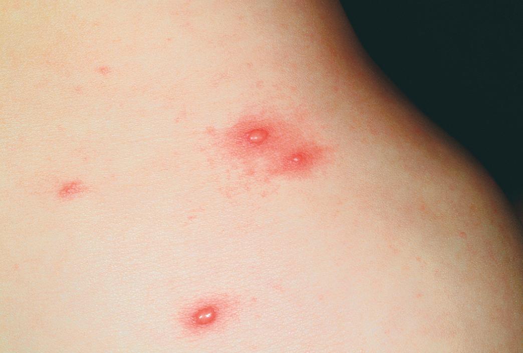 Fig. 53.10, Skin lesions of chickenpox. Note the varying stages of development (macules, papules, and vesicles) present at the same time.