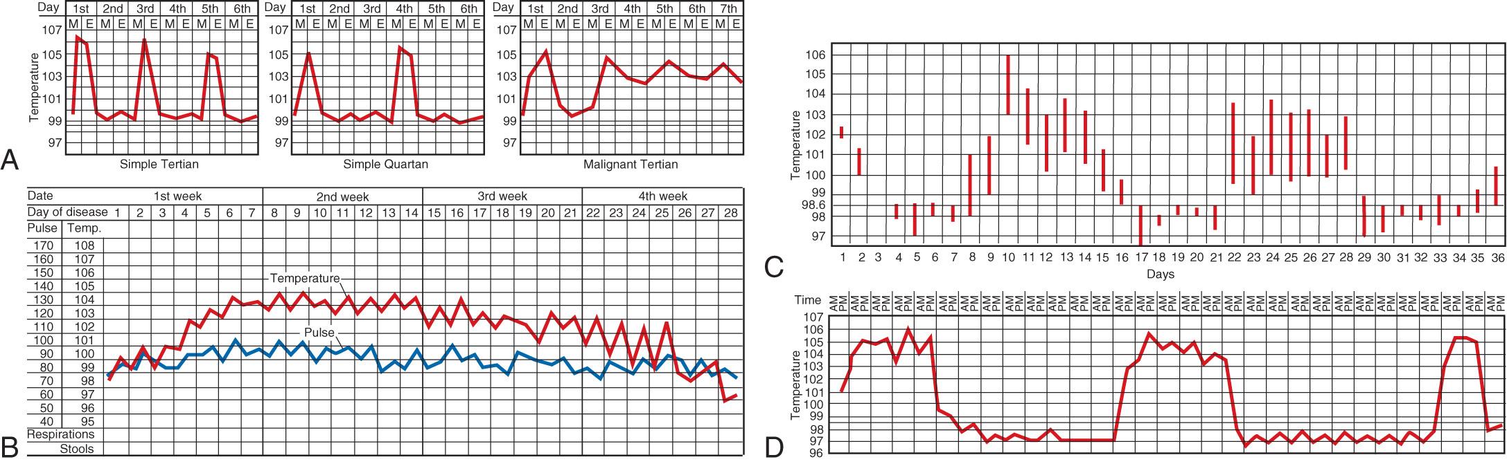 Fig. 204.1, Distinctive fever patterns.