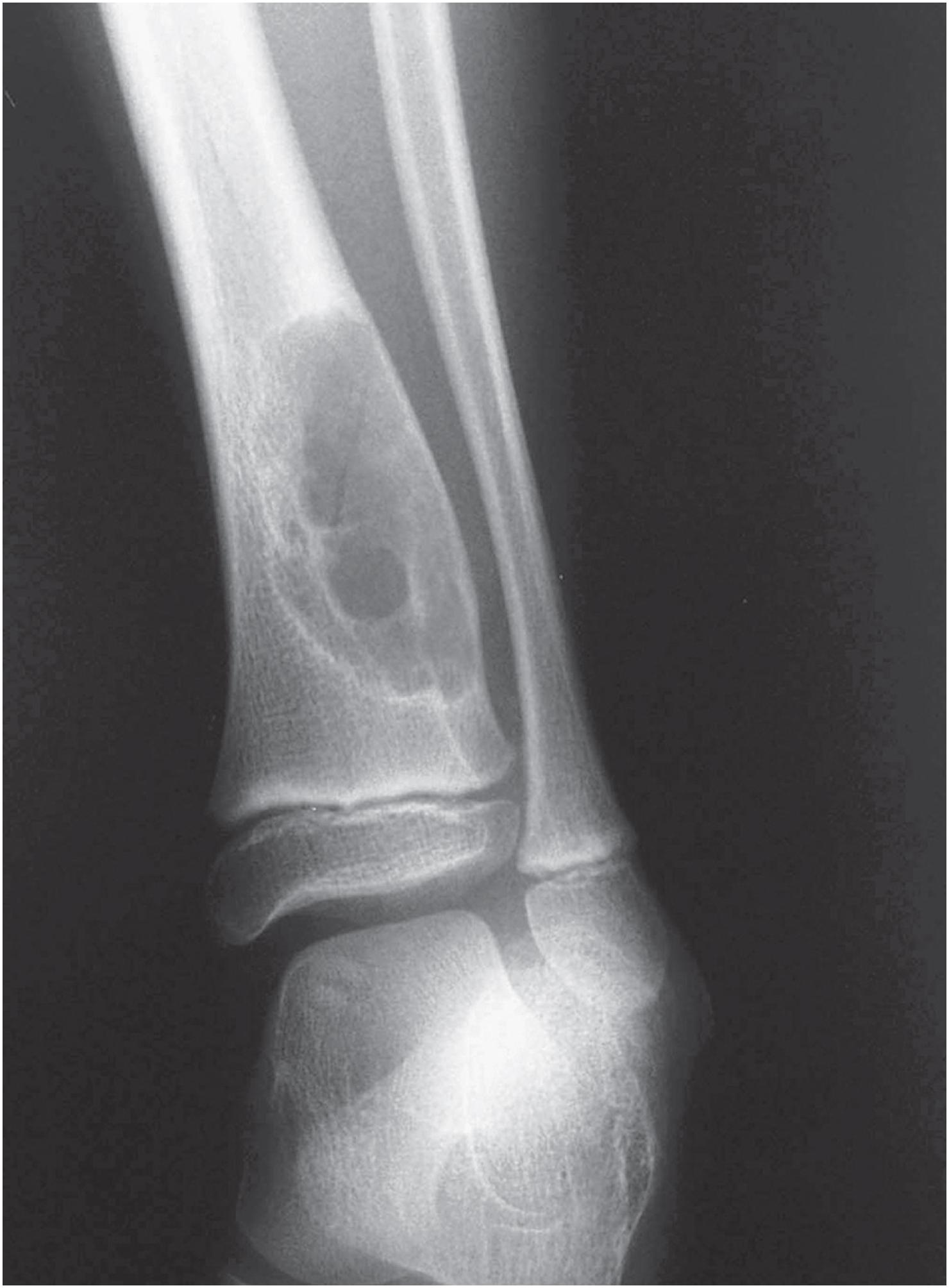 Fig. 18.1, Non-ossifying fibroma: radiographic appearance. Lesions show a well- defined lytic lesion in the metaphyseal portion of a long bone. A sclerotic rim is present.