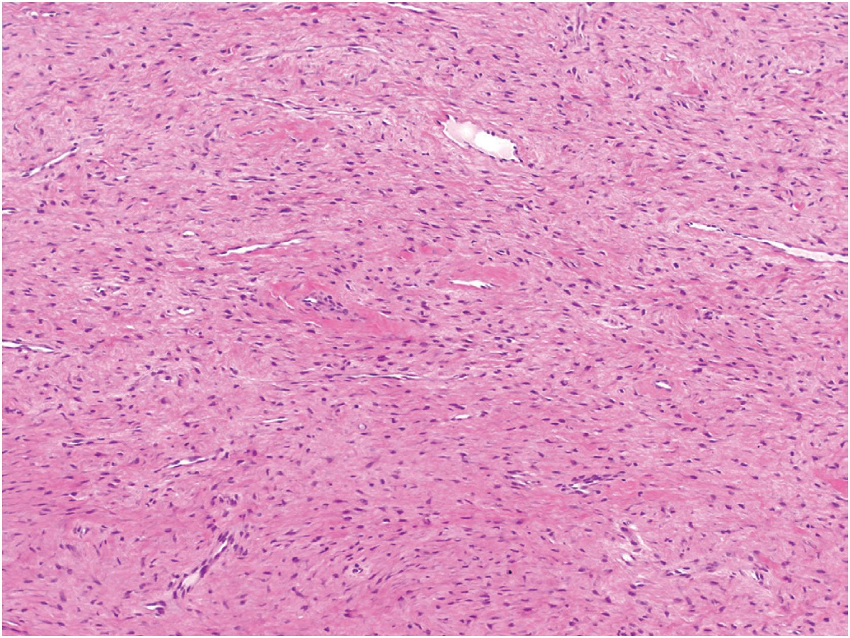 Fig. 18.11, Desmoplastic fibroma of bone: histologic features. Desmoplastic fibroma consisting of fascicles of uniform spindle-shaped cells.