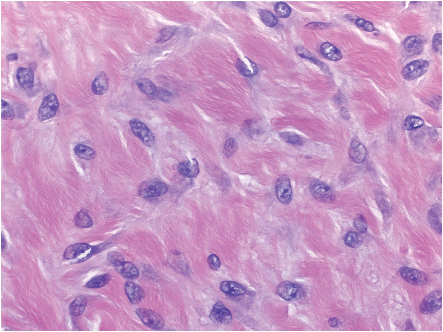 Fig. 18.12, Desmoplastic fibroma of bone: histologic features. The spindle cells show no atypia, mitotic figures are extremely rare.