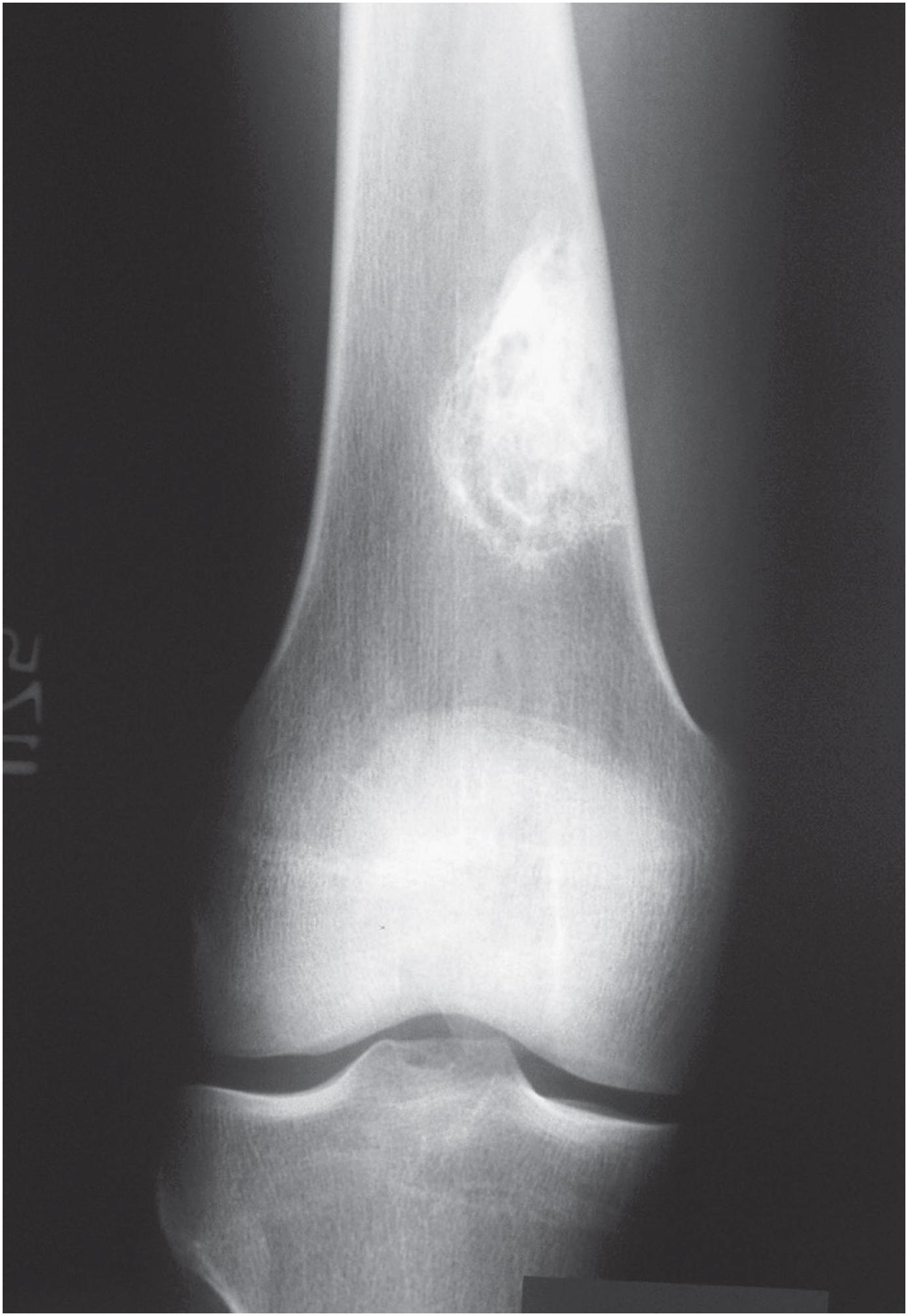 Fig. 18.2, Non-ossifying fibroma: radiographic appearance. Lesions in older patients show features of remodeling. A well-defined radiodensity in the metaphysis adjacent to the cortex.