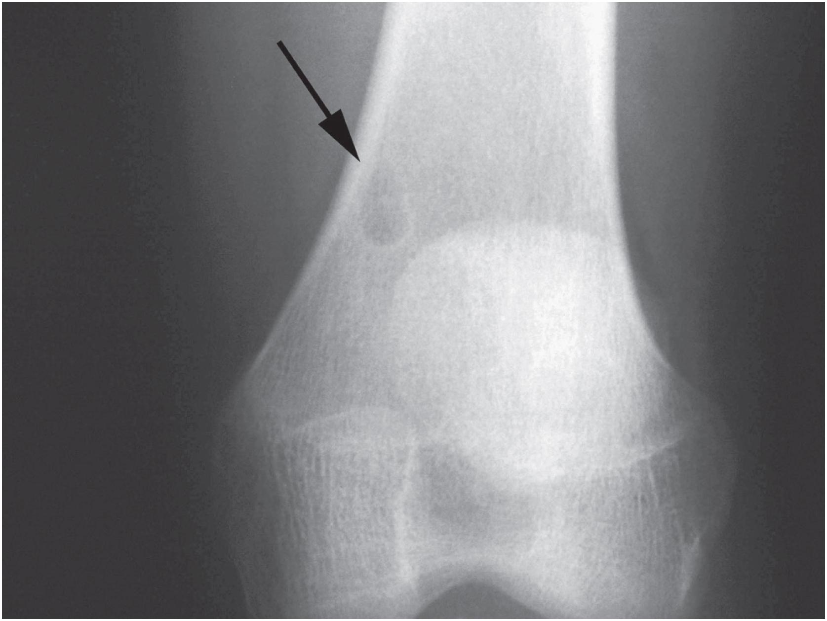 Fig. 18.3, Non-ossifying fibroma: radiographic appearance. Small radiolytic lesions in the metaphysis are also known as fibrous cortical defects (arrow).