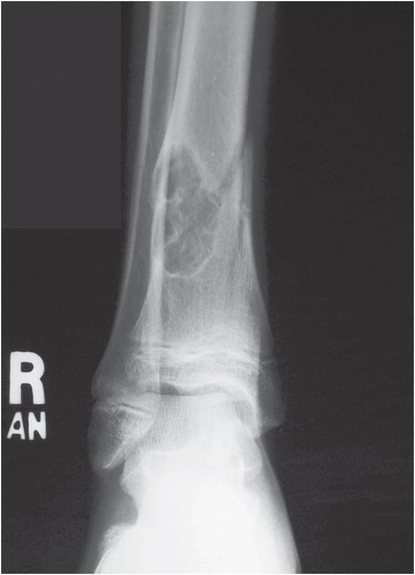 Fig. 18.4, Non-ossifying fibroma: radiographic appearance. Lesions may occasionally present with a pathologic fracture.