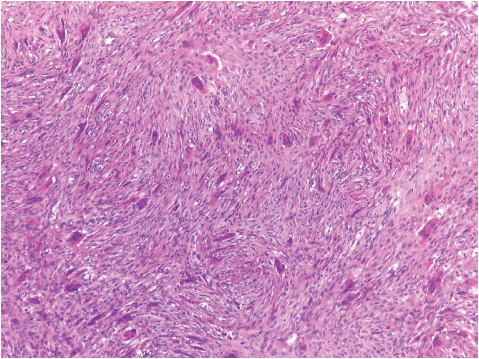 Fig. 18.5, Non-ossifying fibroma: histologic appearance. Low-power view showing bland spindle cells admixed with osteoclast type giant cells. The spindle cells grow in a storiform pattern.