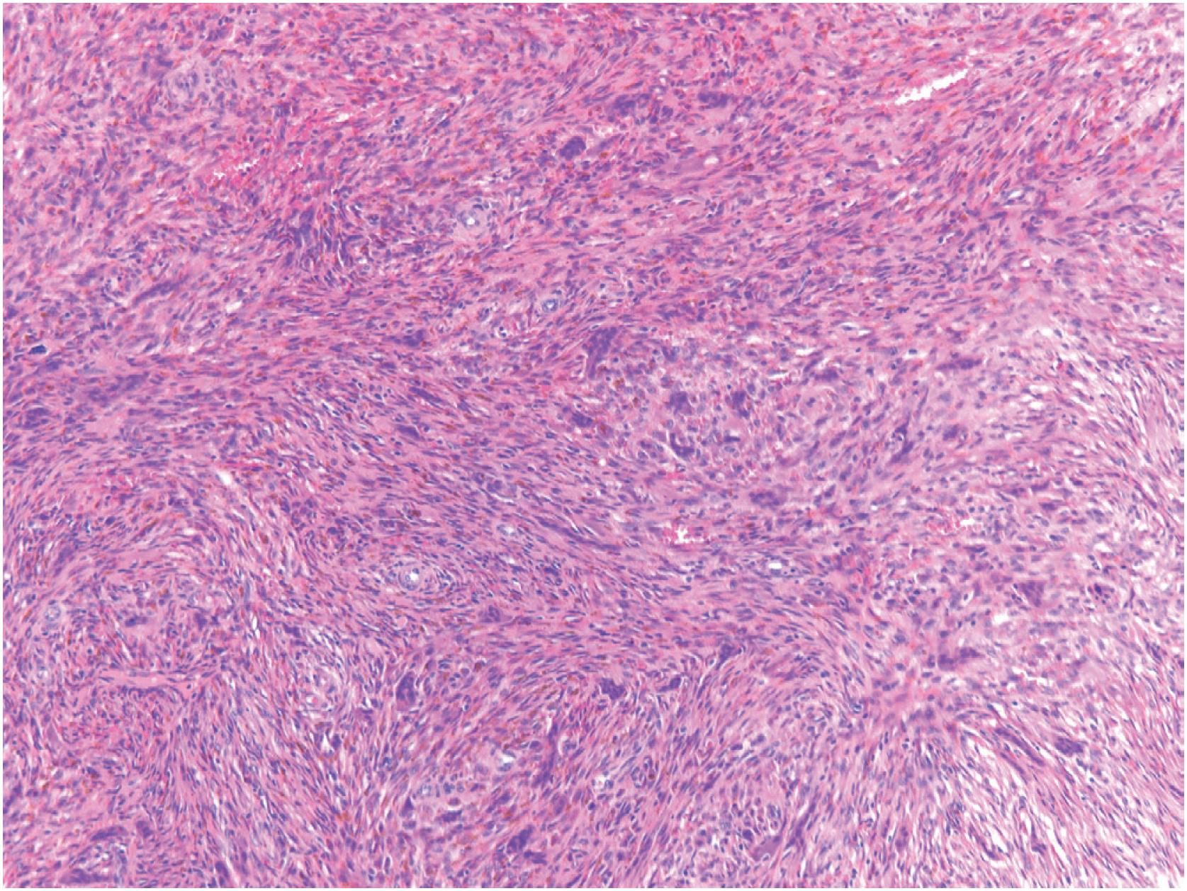 Fig. 18.6, Non-ossifying fibroma: histologic features. The spindle cells are often numerous and contain abundant hemosiderin.