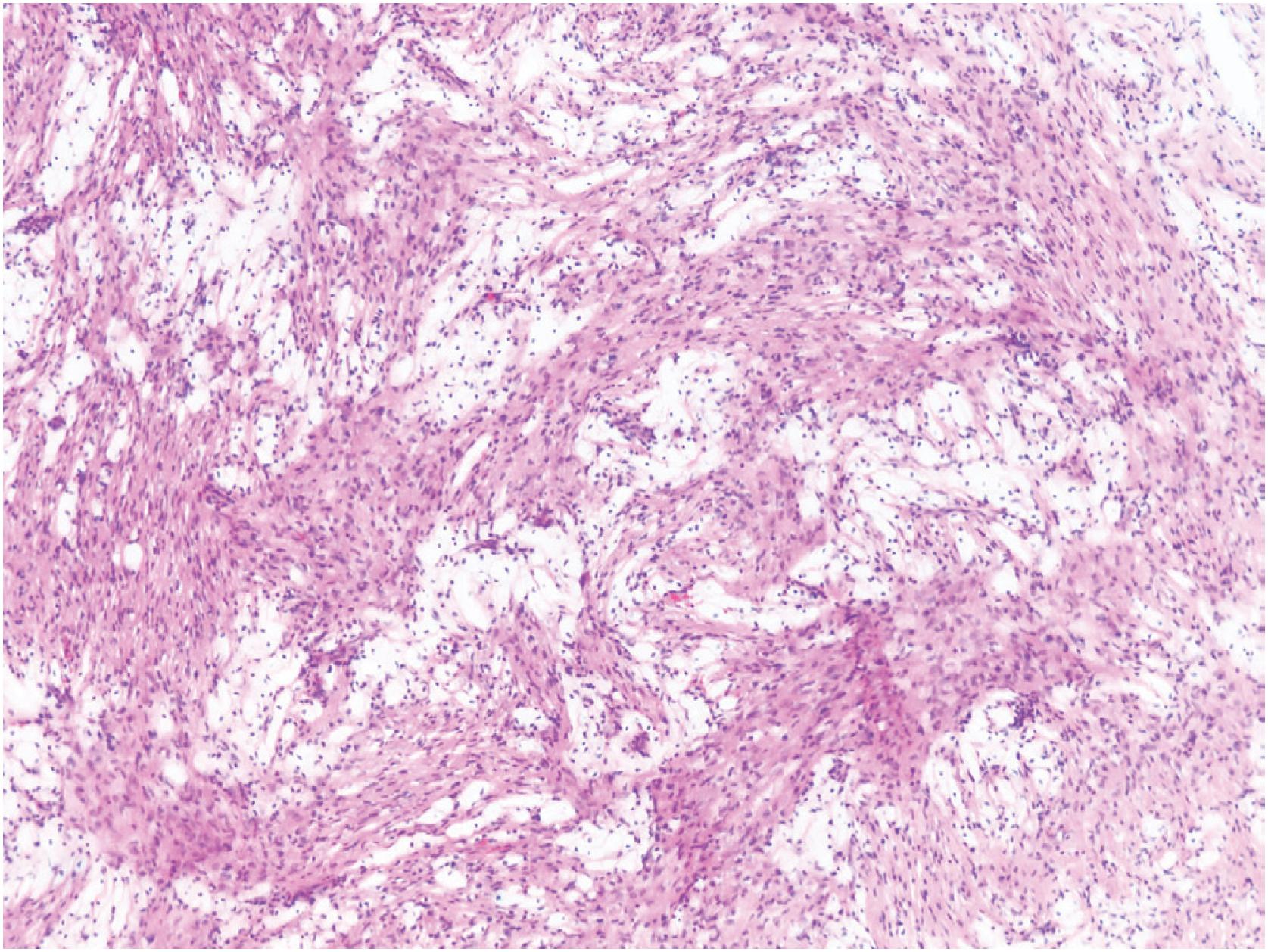 Fig. 18.7, Non-ossifying fibroma: histologic appearance. Lesions often contain large numbers of foam cells.