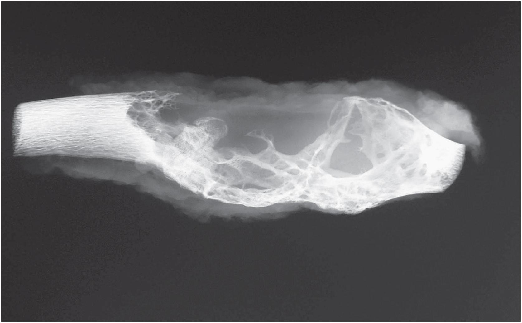 Fig. 18.8, Desmoplastic fibroma of bone: radiographic appearance. This specimen radiograph of a lesion in a rib shows a multilobulated, expansile pattern.