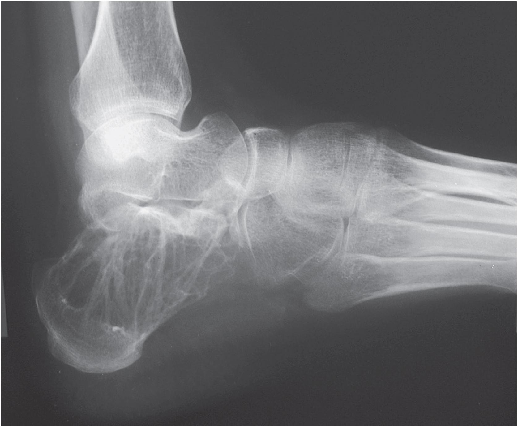 Fig. 18.9, Desmoplastic fibroma of bone: radiographic appearance. This tumor of the calcaneus shows a well-defined and bubbly-appearing osteolysis.