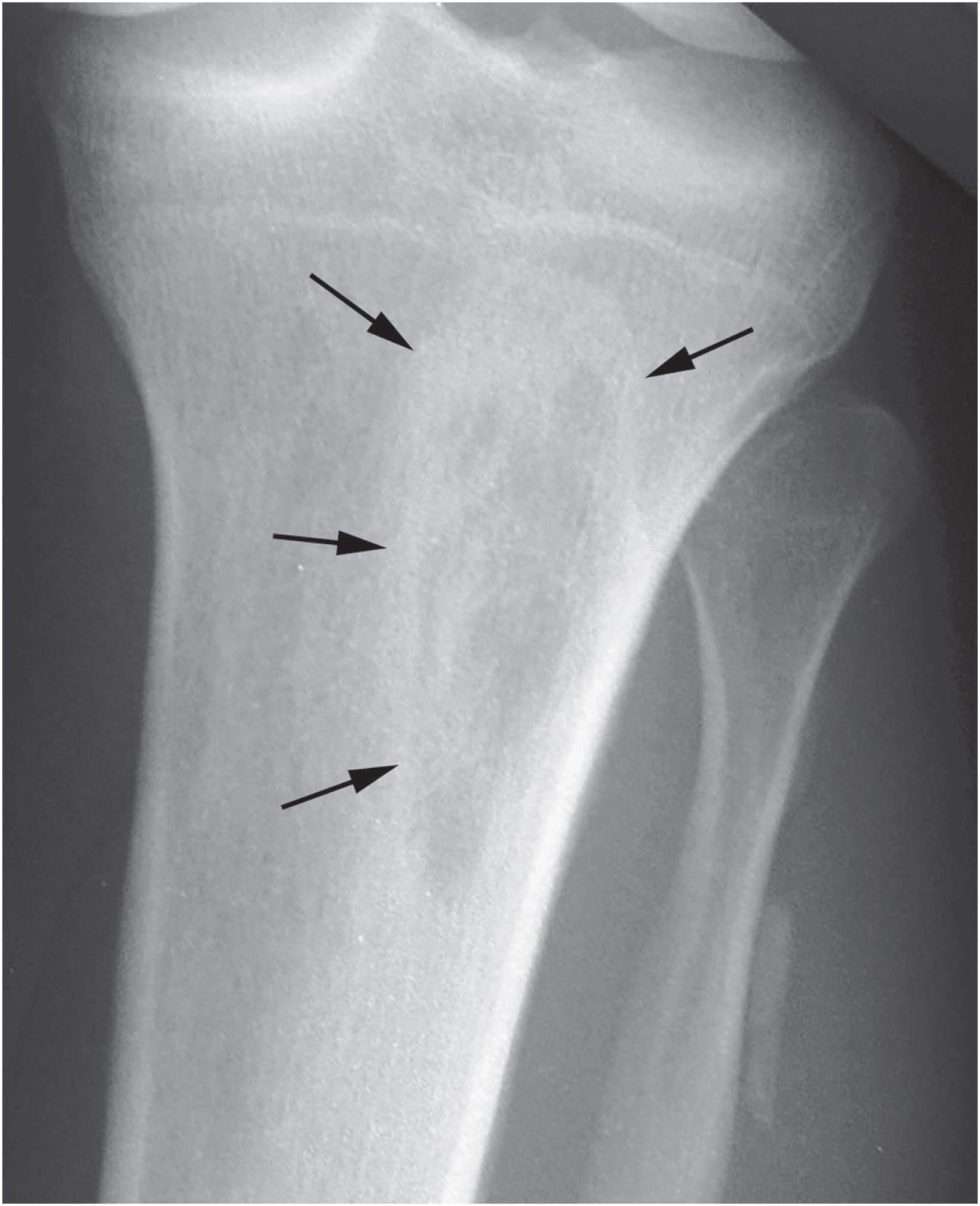 Fig. 18.10, Desmoplastic fibroma of bone: radiographic appearance. This lesion in the proximal tibia is well defined and involves the metaphyseal portion of the bone.