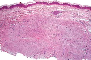 Fig. 1, Hypertrophic scar.