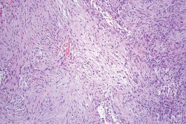 Fig. 4, Nodular fasciitis.