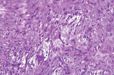 Fig. 5, Nodular fasciitis.