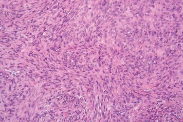 Fig. 7, Nodular fasciitis.