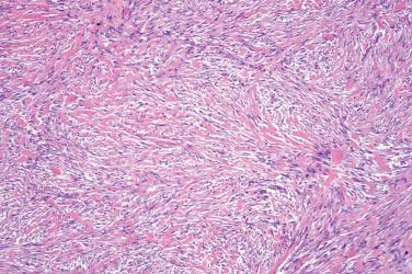 Fig. 8, Nodular fasciitis.