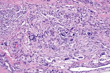 Fig. 9, Nodular fasciitis.