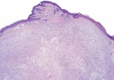 Fig. 1, Intradermal nodular fasciitis.