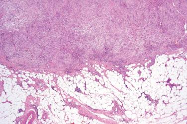 Fig. 2, Intradermal nodular fasciitis.