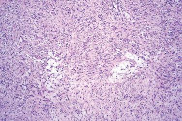 Fig. 3, Intradermal nodular fasciitis.