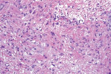 Fig. 3, Proliferative fasciitis.