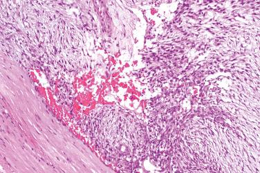 Fig. 2, Intravascular fasciitis.