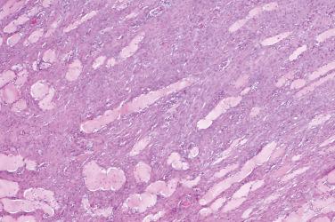 Fig. 1, Proliferative myositis.