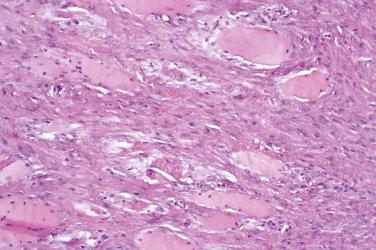 Fig. 2, Proliferative myositis.