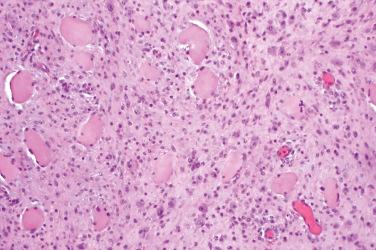 Fig. 3, Proliferative myositis.