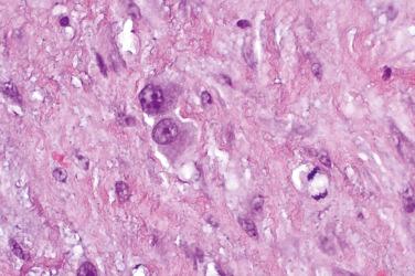 Fig. 5, Proliferative myositis.