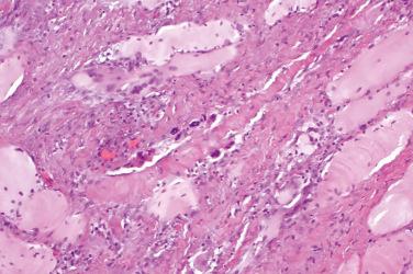 Fig. 6, Proliferative myositis.