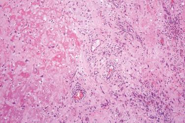 Fig. 2, Ischemic fasciitis.